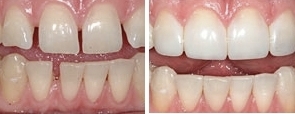 tooth bonding before and after